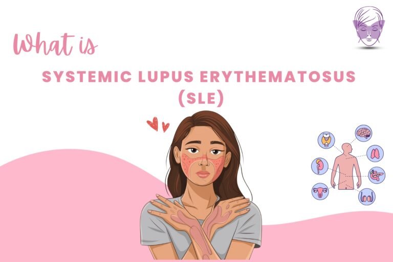 What is Systemic lupus erythematosus (SLE)? Symptoms, Causes